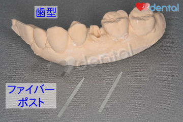 ファイバーポスト 間接法